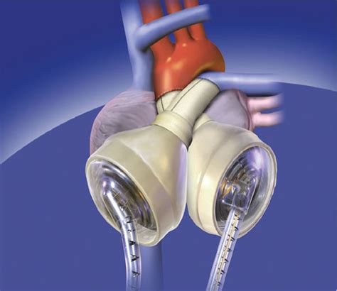 Baptist Health Implants Arkansas’ First Total Artificial Heart ...