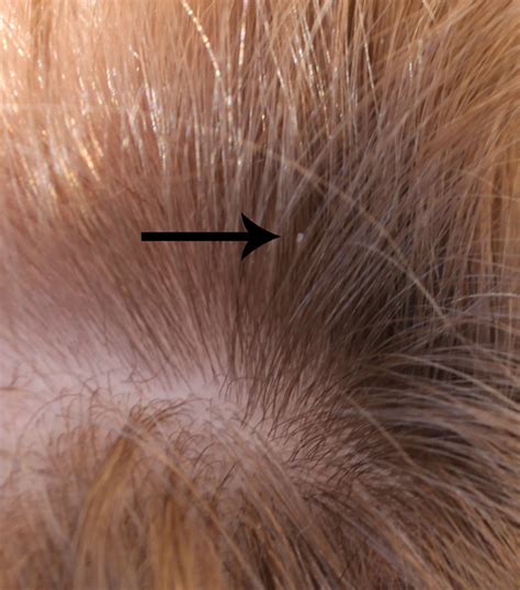 Head Lice Eggs On Blonde Hair | www.imgkid.com - The Image Kid Has It!