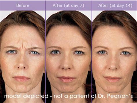 Botox - Dr. James Pearson Facial Plastic Surgery