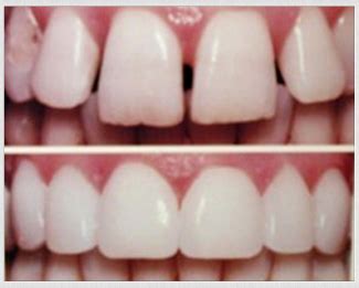 Composite Veneers Pros And Cons