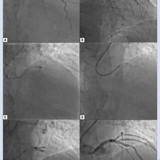 Coronary angioplasty of the left anterior descending artery using ...