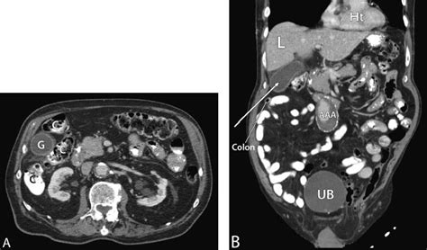 Percutaneous Cholecystostomy | Radiology Key