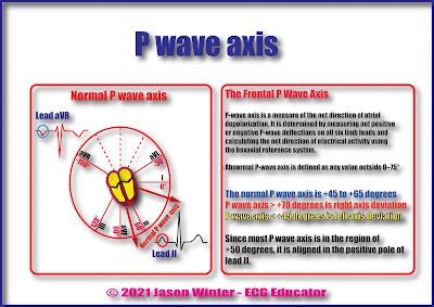 ECG Educator Blog : P axis on an ECG