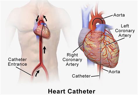 Cardiac Catheterization Procedure - The Steps, Duration, Heart Cath Risks