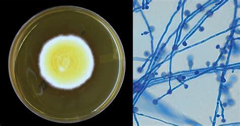 Blastomyces dermatitidis- An Overview