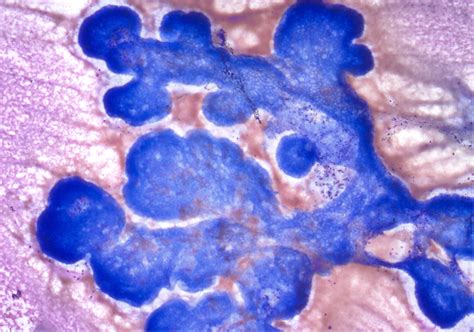 IPMN, EUS-FNA; An IPMN depicting neoplastic mucinous epithelium with a ...