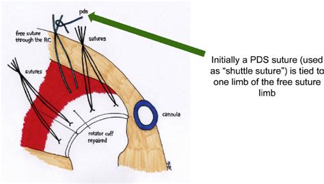 PDS suture (used as the shuttle suture) is tied to one suture limb of... | Download Scientific ...