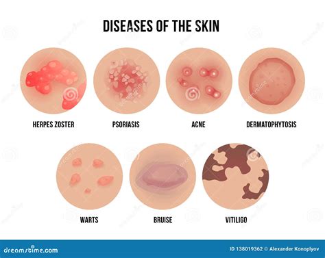 Skin Disease, Types of Dermatology Problems with Names Stock Vector - Illustration of beauty ...