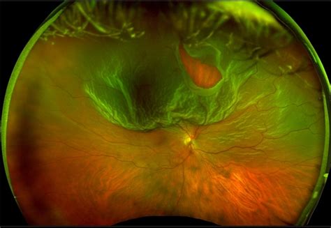 Optos Giant Tear within Retinal Detachment - Retina Image Bank