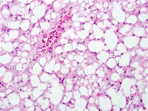 Acute Hepatic Necrosis - LiverTox - NCBI Bookshelf