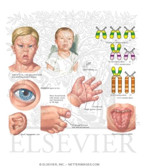 Trisomy 21 (Down Syndrome)