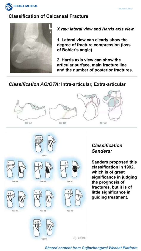 Calcaneal Fracture Mechanism Injury,Classification Of Calcaneal Fracture-www.doublemedicalgp.com