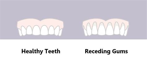 Gum Recession: Symptoms, Causes and Prevention