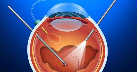 Vitrectomy | Indications | Procedure | Cost - Sutured