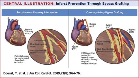 PCI and CABG for Treating Stable Coronary Artery Disease,Journal of the American College of ...