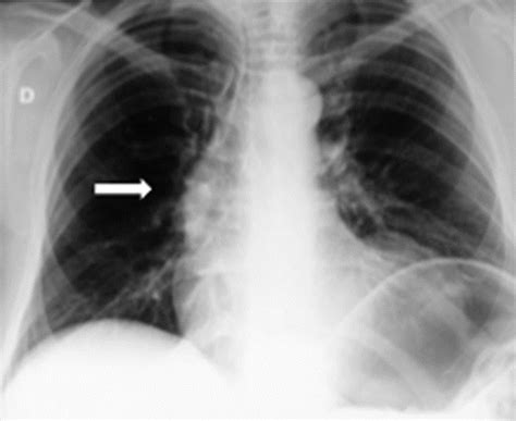 Advanced-stage Hodgkin Lymphoma: US/Chest Radiography for Detection of Relapse in Patients in ...