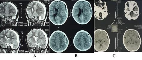 Figure 2 from Management of subdural hygroma in infants and children | Semantic Scholar