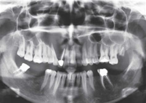 Odontogenic keratocyst, definition, causes, symptoms, diagnosis ...