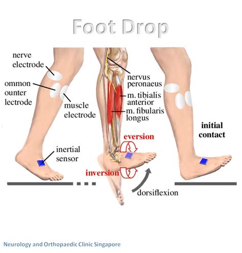 Foot Drop: What It Is, Causes, Symptoms Treatment | atelier-yuwa.ciao.jp