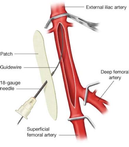 Medisonru Superficial Femoral Artery Common Femoral