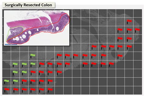 Biopsy flagged with regions of ‘high’ (red) and ‘low’ suspicion... | Download Scientific Diagram