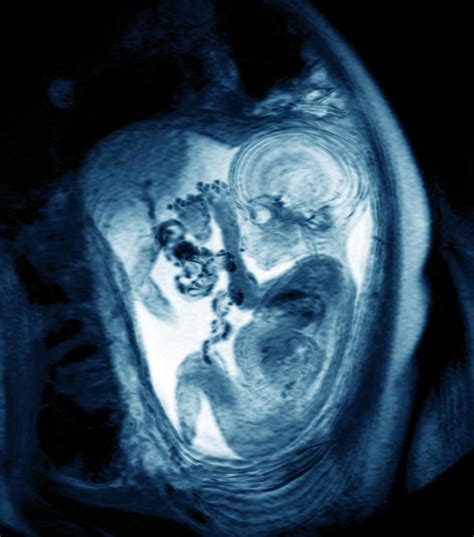 Early Pregnancy Mri - PregnancyWalls