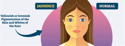 Jaundice in Adults: Causes, Symptoms and Treatment