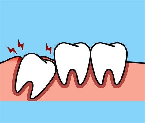 Wisdom teeth - Ballaratdentalgroup.com.au