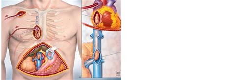 Comparative Effectiveness of Median Sternotomy vs Minimal Access Cardiopulmonary Bypass and ...