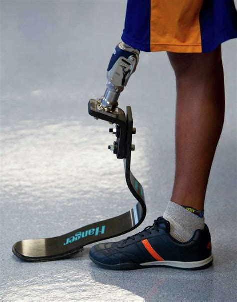 Runner from Mexico receives prosthetic leg