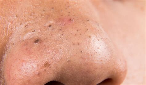 Comedonal Acne: Signs and How to Treat – Tiege Hanley