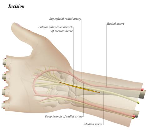 Volar Approach to Wrist - Approaches - Orthobullets