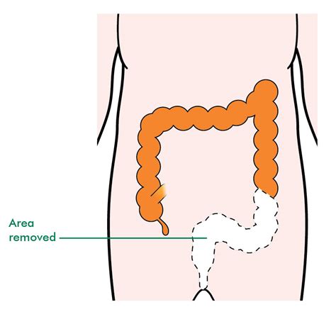 Bowel Resection Surgery And Weight Loss