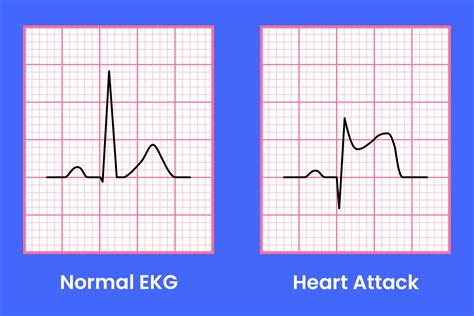 EKG for Heart Attack: Symptoms, Diagnosis & Treatment
