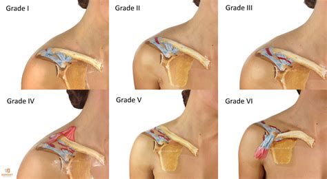 AC Joint Pain: What is it and how do I fix it? - Physiosteps