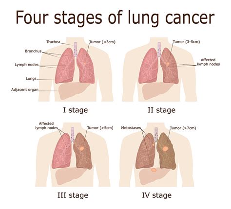 Lung Cancer: Risk Factors, Warning Signs, and Treatment