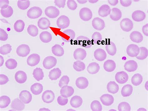 Diagnosis of thalassemia