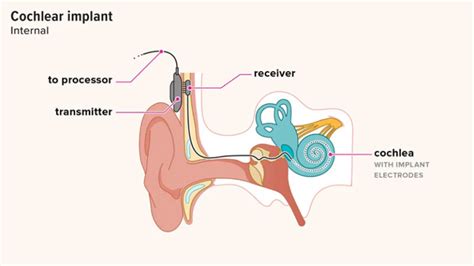 What are cochlear implants and how do they work?