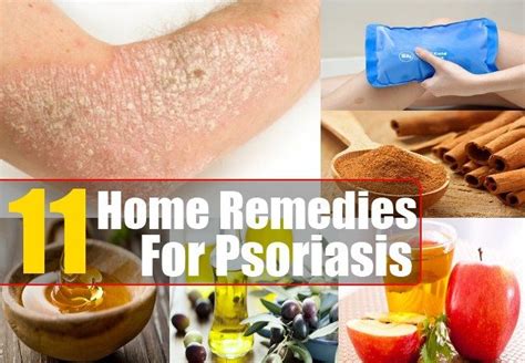 11 Home Remedies For Psoriasis | Home remedies for psoriasis, Psoriasis remedies, Natural ...