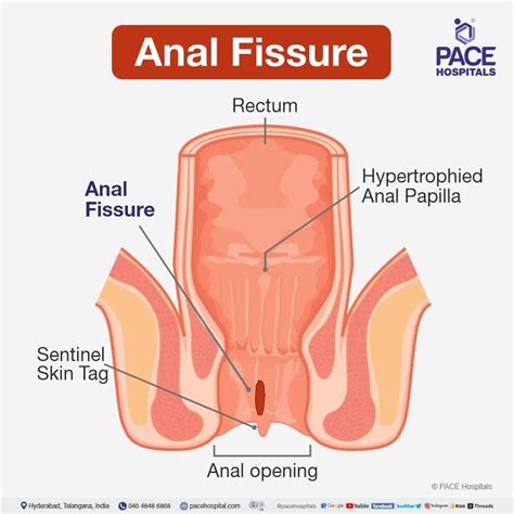 Anal Fissure - Symptoms, Causes, Types, Complications, Prevention