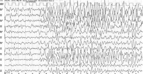 Ictal EEG recording (20 s) of temporal lobe seizure in a 7-year-old boy ...