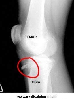 x-ray photos of bone spurs | figure 1 lateral x ray of knee with tibial ...