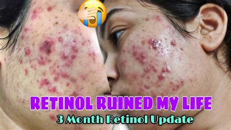 RETINOL SIDE EFFECTS MY 3 MONTH ACNE JOURNEY| RETINOL BEFORE & AFTER ...