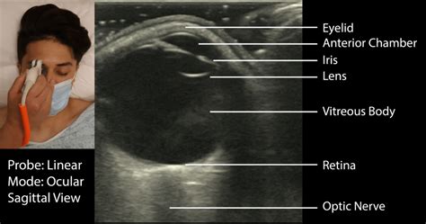 Eye Ultrasound