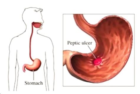 How Do Should Deal With the Peptic Ulcer Disease | Peptic ulcer, Health, Ulcers