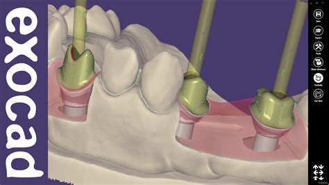 exocad Video Tutorial (basic): Custom Abutment Design - YouTube