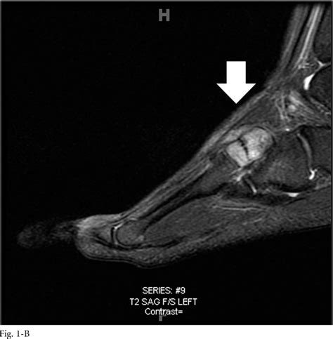 Cuneiform Bone Fracture