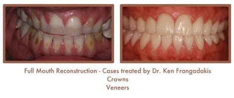 Before & After Full Reconstruction Gallery, Photo Gallery, Dentist ...