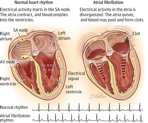 Atrial Fibrillation | Atrial Fibrillation | JAMA | JAMA Network