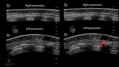 Male Gynecomastia Ultrasound